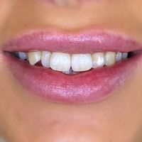 Composite Bonding - Smile 16 before